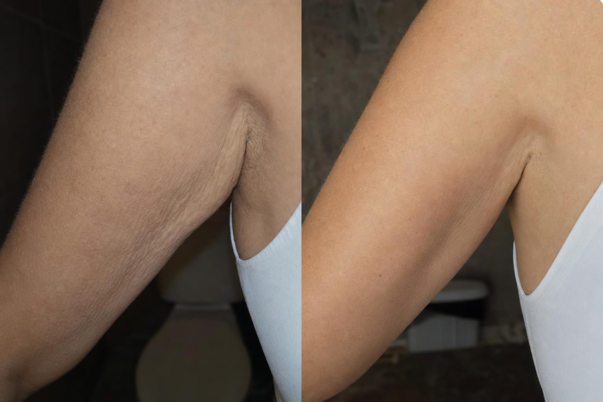 Before and after firming body oil results on crepey skin