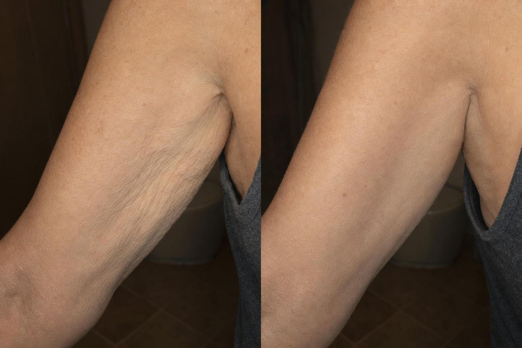 Before and after firming results on arm skin with Cavo Glow Body Oil